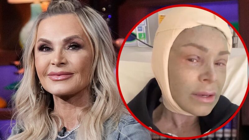 Tamra Judge partage son expérience post-opératoire après une chirurgie esthétique