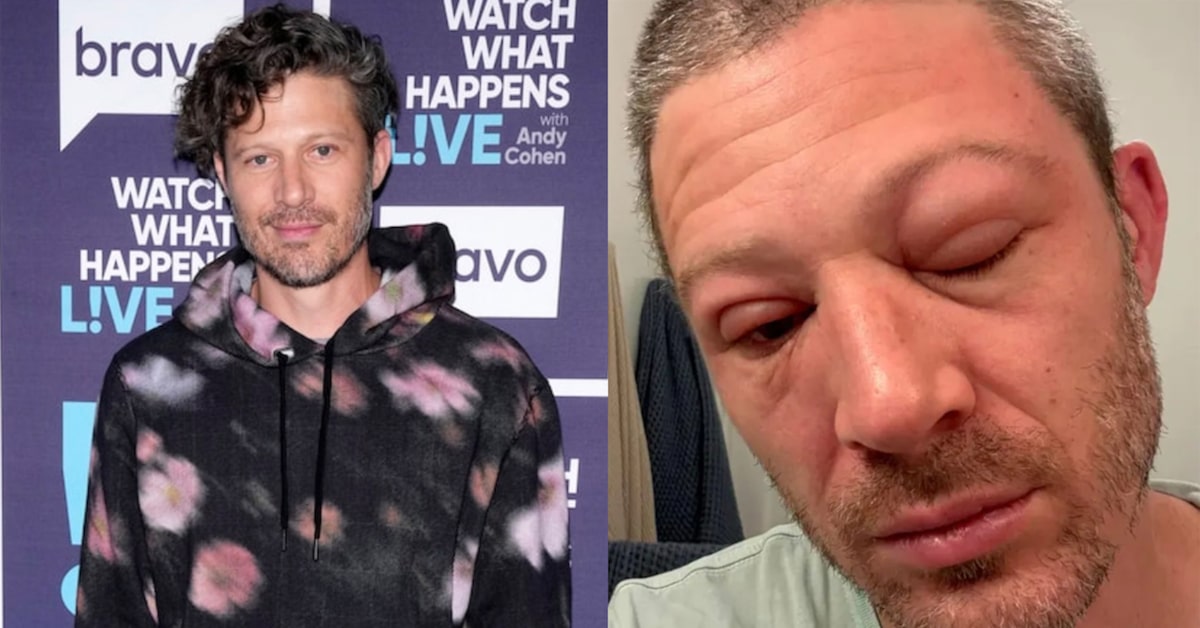 Zach Gilford souffre d’un gros gonflement du visage après un problème de santé