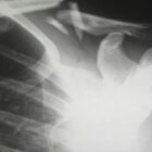 How to Manage the Emotional Impact of a Serious Injury